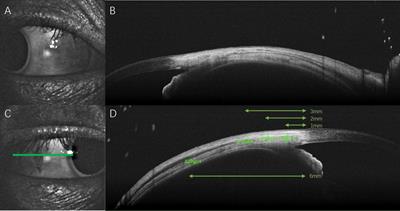 Scleral changes in systemic lupus erythematosus patients using swept source optical coherence tomography